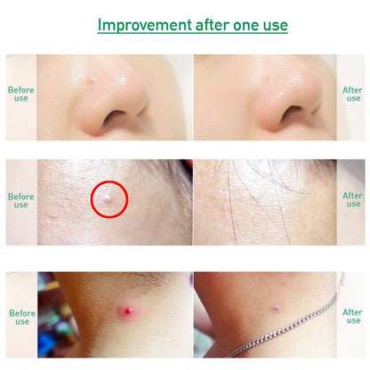 ACROPASS - Trouble Cure Set ( pack 6)